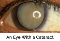 Mature Cataract