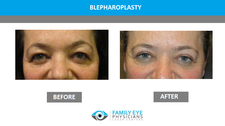 Blepharoplasty before and after eye surgery photos