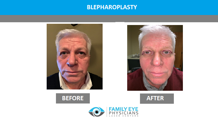 Blepharoplasty before and after eye surgery photo of man