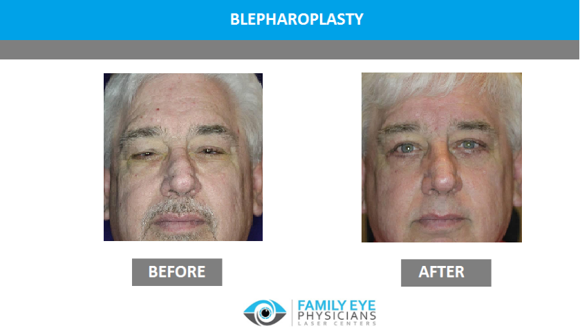 droopy eyelid before and after photos