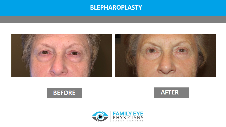 Blepharoplasty before and after photos